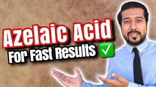 Azelaic Acid for Melasma | How to Use Azelaic Acid for SUCCESS 🏆
