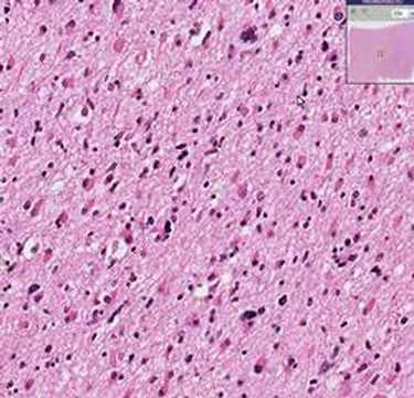 histopathology brain astrocytoma youtube