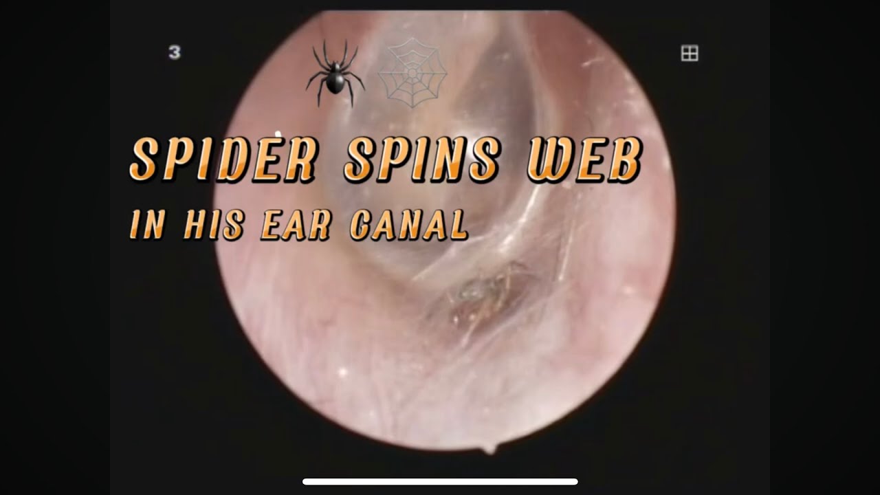 Web In Ear SPIDER SPINS WEB IN HIS CANAL - YouTube