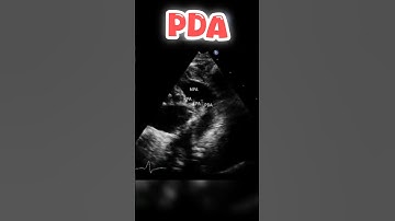 Patent Ductus Arteriosus pda on #echocardiography #heart