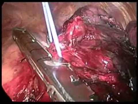 VATS lobectomy- Lobectomía videotoracoscópica - YouTube
