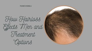 Understanding Androgenic Alopecia in Men: Treatment Options