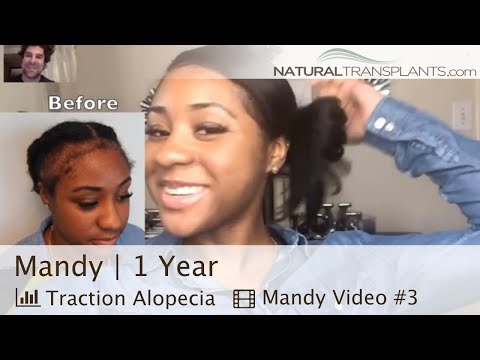 traction-alopecia-regrowth-|-i-got-my-edges-back-after-traction-alopecia-(mandy)