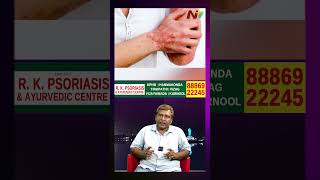 సోరియాసిస్ - రకాలు, లక్షణాలు..! | Rk Psoriasis & Ayurvedic Center | Ntv