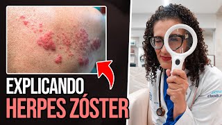 Herpes Zoster - Sintomas, Complicações e Prevenção
