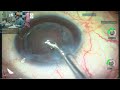 Live cataract surgery by dr sudhir srivastava uttara eyecon 2022 at drishti eye institute