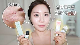 안좋은 피부 탈출 하게 만들어준...⭐️여드름 스팟템 4대천왕⭐️