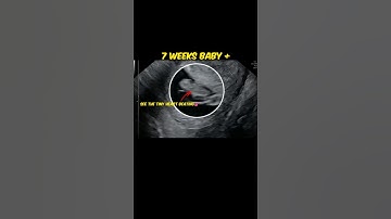 What 7 Weeks Pregnant Really Looks Like on Ultrasound!