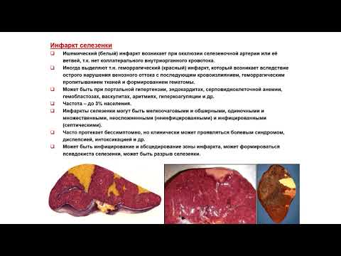 УЗИ. Доктор Иогансен. Выпуск 64. Неопухолевые очаговые изменения селезенки. Часть 2.
