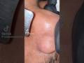 Men’s Nose Extractions