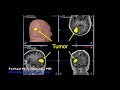 Brain Tumor Surgery: Removal of Glioblastoma (GBM) with abscess content