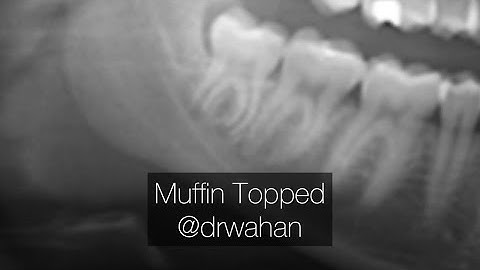 Third Molar Extraction with Horizontal Crown Sectioning and Root Sectioning: Muffin Top