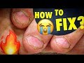 Amazing Transformation of Extremely Bitten Nails How to Fix Short Bitten Nails