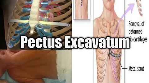 Pectus Excavatum | Funnel Chest | Congenital Defor...