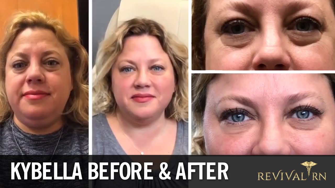 KYBELLA Before & After Treatment Journey with Cosmetic Injector Erin Jedrusik Revival RN YouTube