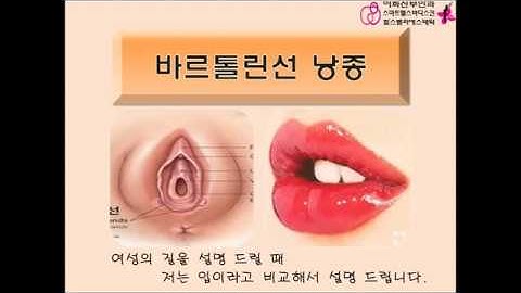 바르톨린선 낭종