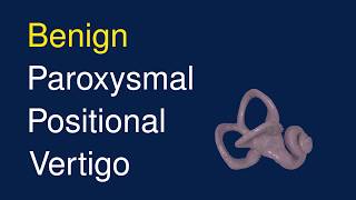 Benign Paroxysmal Positional Veritgo (BPPV)