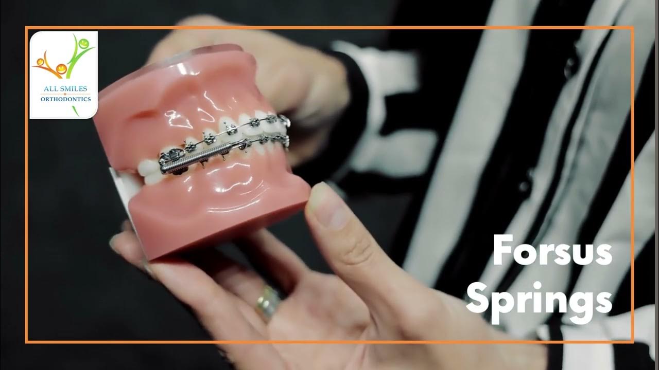Forsus Springs YouTube