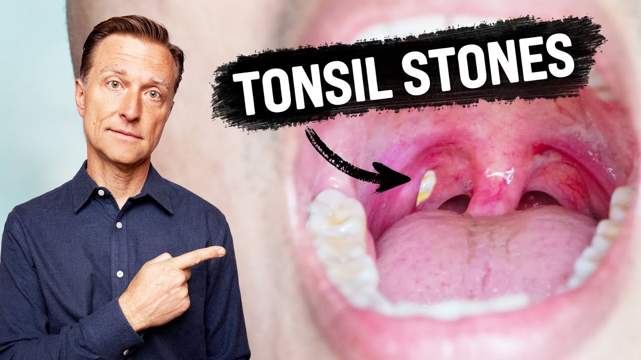 What CAUSES Tonsil Stones and How to Prevent Them￼