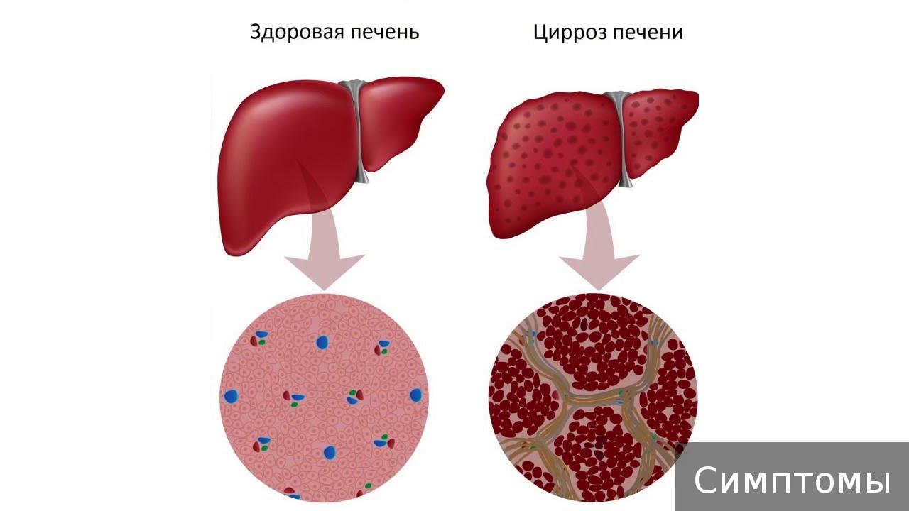 Алкогольный цирроз симптомы у мужчин. Алкогольный цирроз печени. Алкогольная болезнь печени.