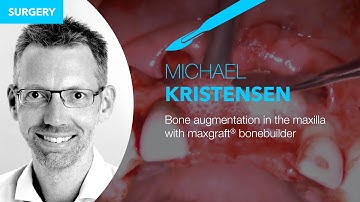 Bone augmentation in the maxilla with maxgraft® bonebuilder