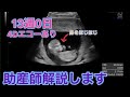 4Dエコーあり 妊娠13週 助産師解説します。