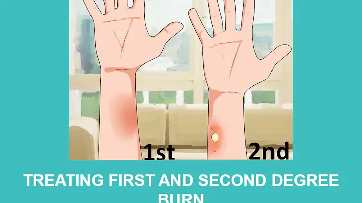 How to treat a burn?