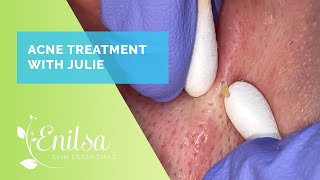 Acne Treatment & Extractions on Julie - New Patient!