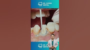 Thay đổi nụ cười với 1 chiếc răng hỏng | Dr Cường Official
