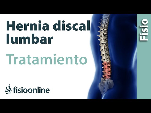 Lumbares tipos discales de hernias
