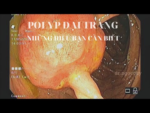 POLYP ĐẠI TRÀNG, NHỮNG ĐIỀU BẠN CẦN BIẾT