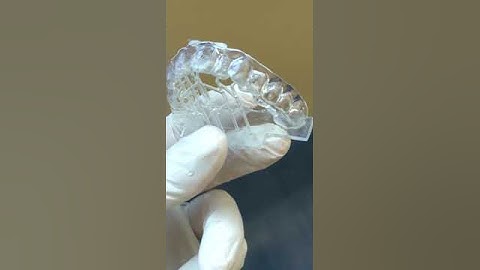 3Dresyns 3D printed aligner printed with 3Dresyn OD-Clear TF LTP (www.3dresyns.com)