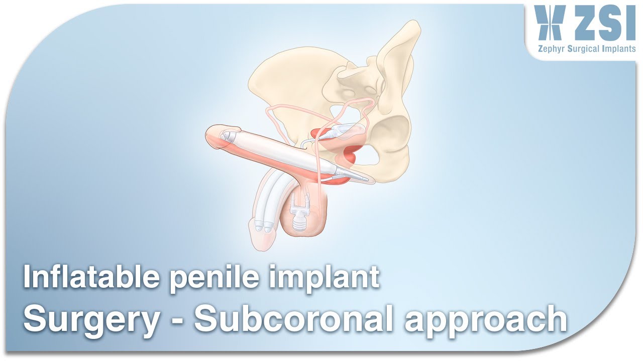 5. Inflatable penile implant surgery - subcoronal approach 1/3 (ref: ZSI 475)