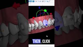 BSP5.0: Never Plan a Midcourse Refinement Case Ever Again! #aligners