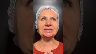 #ботокс #диспорт #межбровка #морщины #botox #botoxfullface #морщинывокругглаз #морщиныналбу #брыли