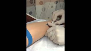 IV insertion mastery