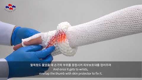 HM Cast procedure (Long arm)