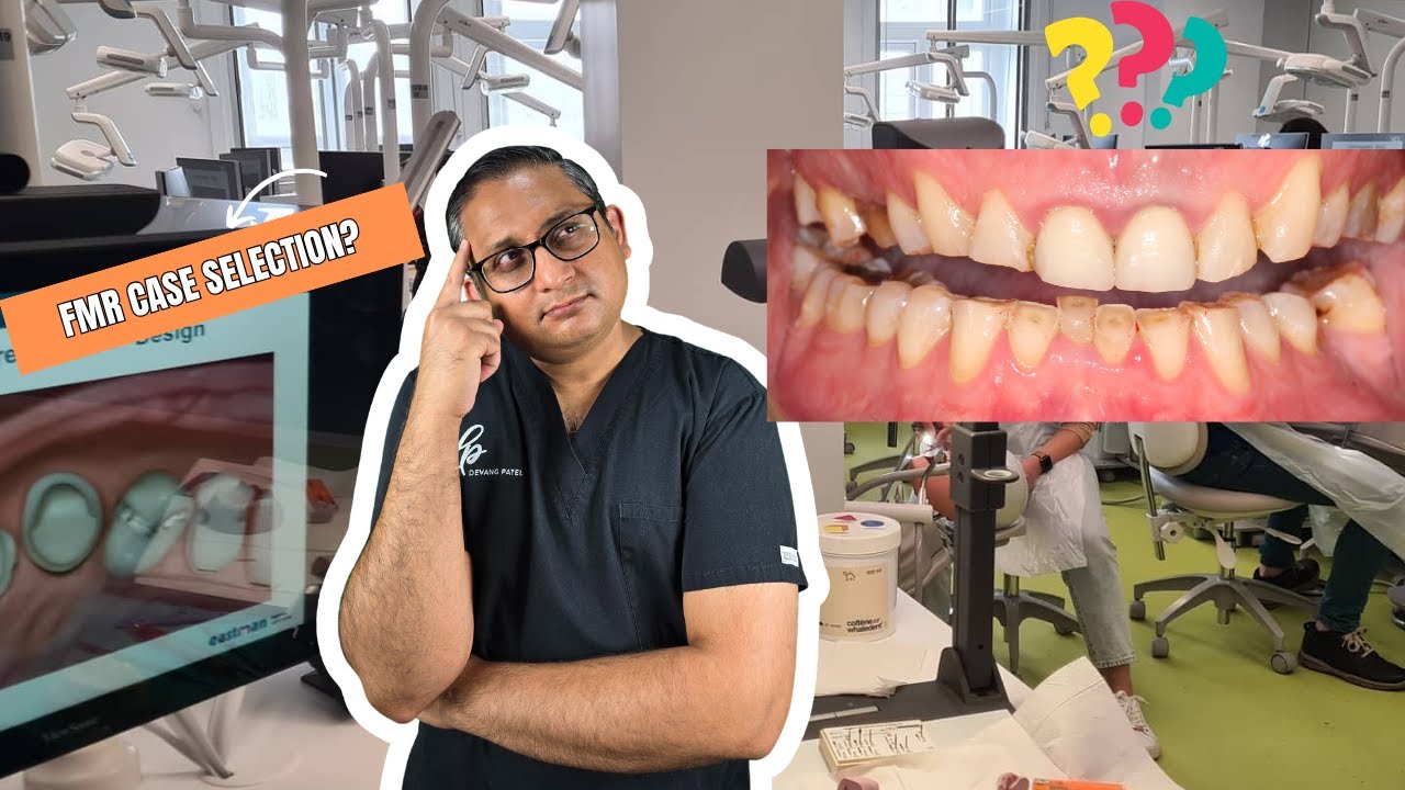 Full Mouth Reconstruction Case Selection