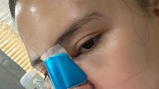 Nagpa Rhinoplasty Ako At Bakit?