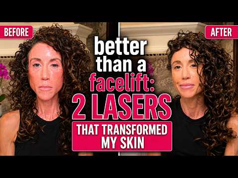 Better Than a Facelift 2 Lasers That Transformed My Skin