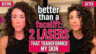 Better Than a Facelift   2 Lasers That Transformed My Skin