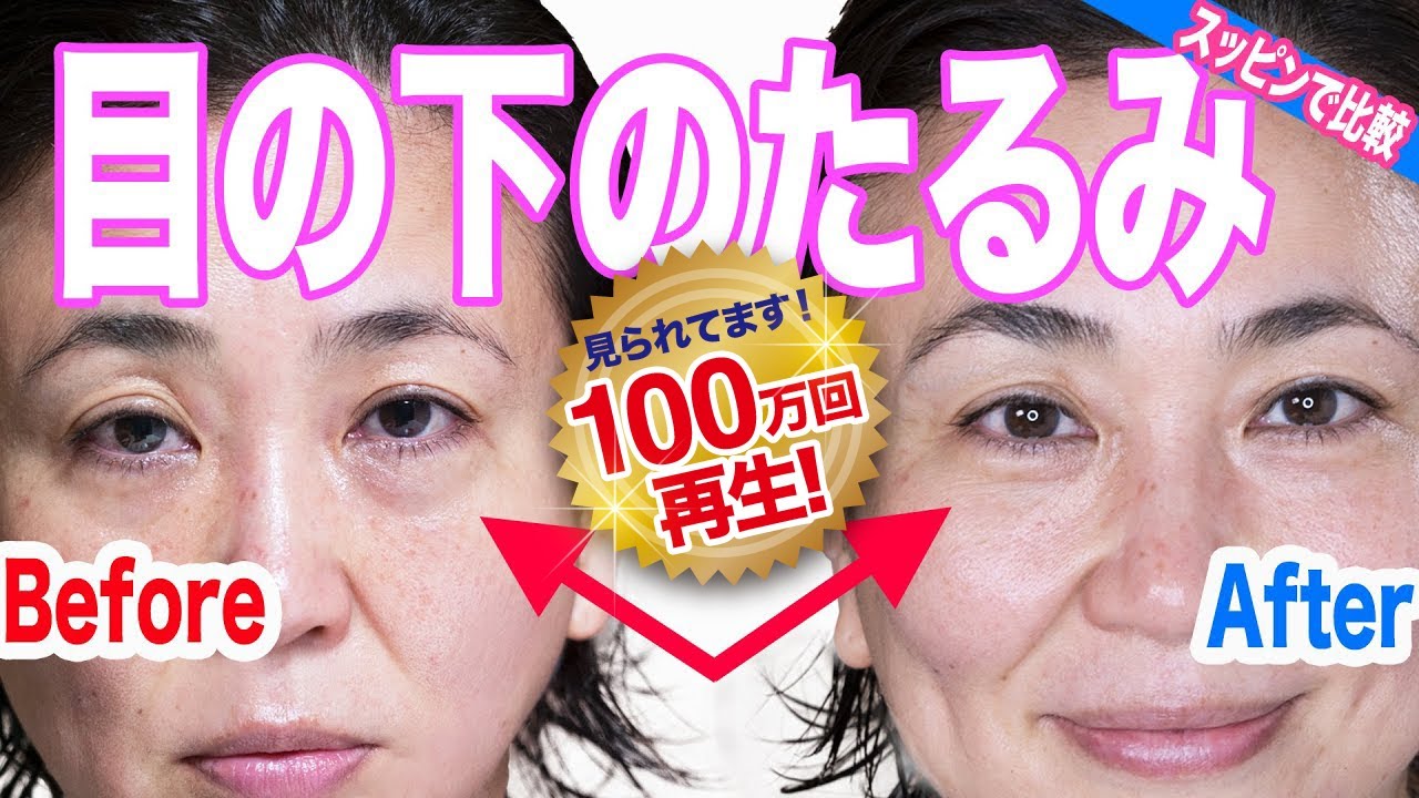目の下のたるみの原因