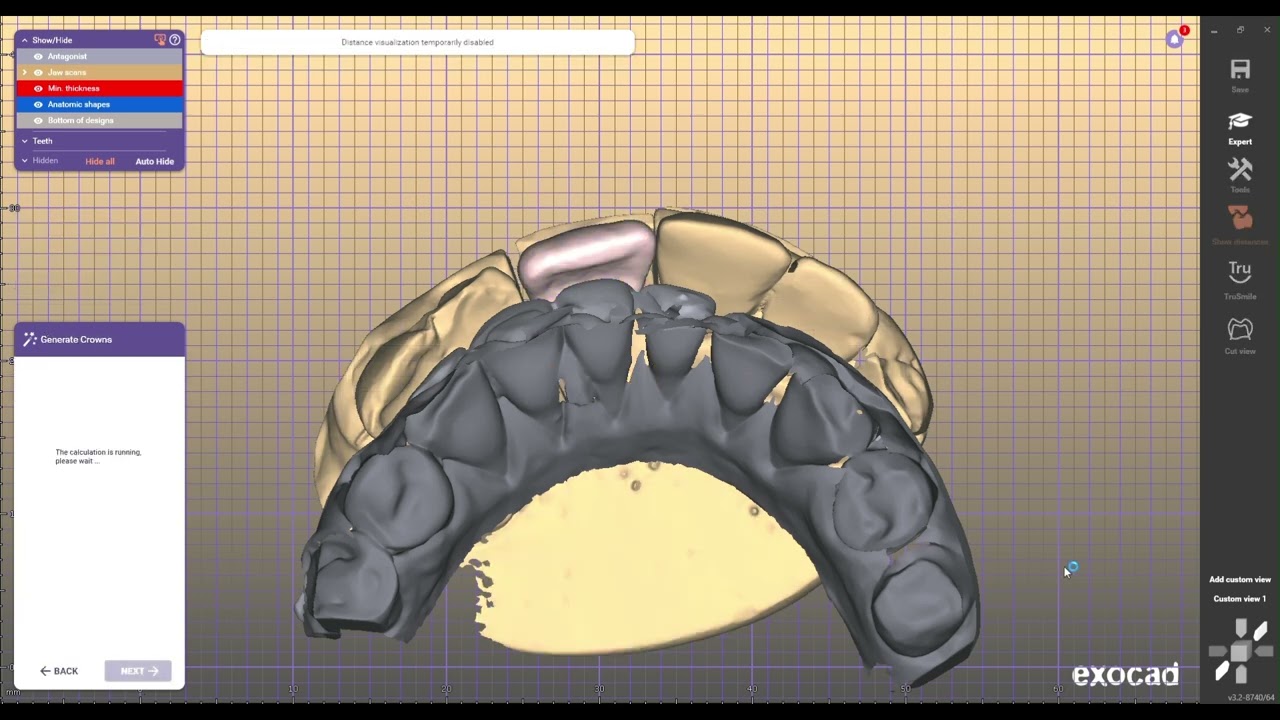 DENTAL TEETH DESIGN FOR EXOCAD