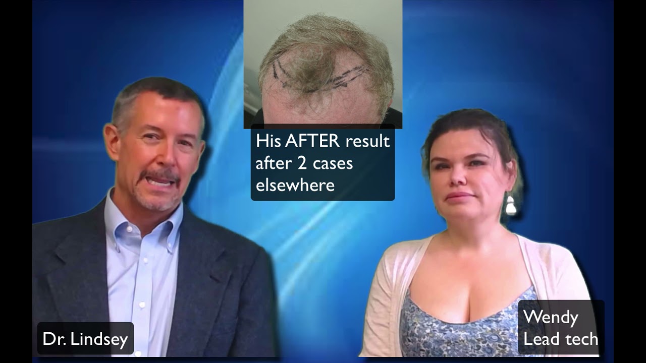 Hair transplant repair by Dr. Lindsey in Washington DC on a tough guy | McLean | Virginia | DC