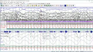 Natus EEG/PSG Tutorial: NeuroWorks-SleepWorks 9 Traces Visualization