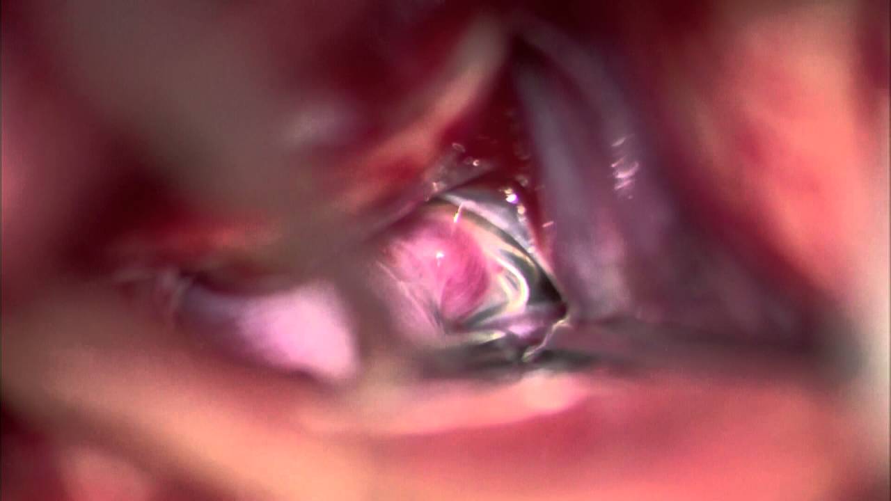 Right Posterior Communicating Artery Recurrent Aneurysm Clip