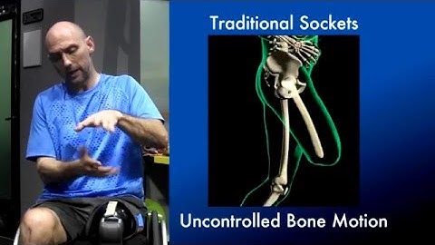 AK Amputee Describes the Benefits of his HiFi Socket