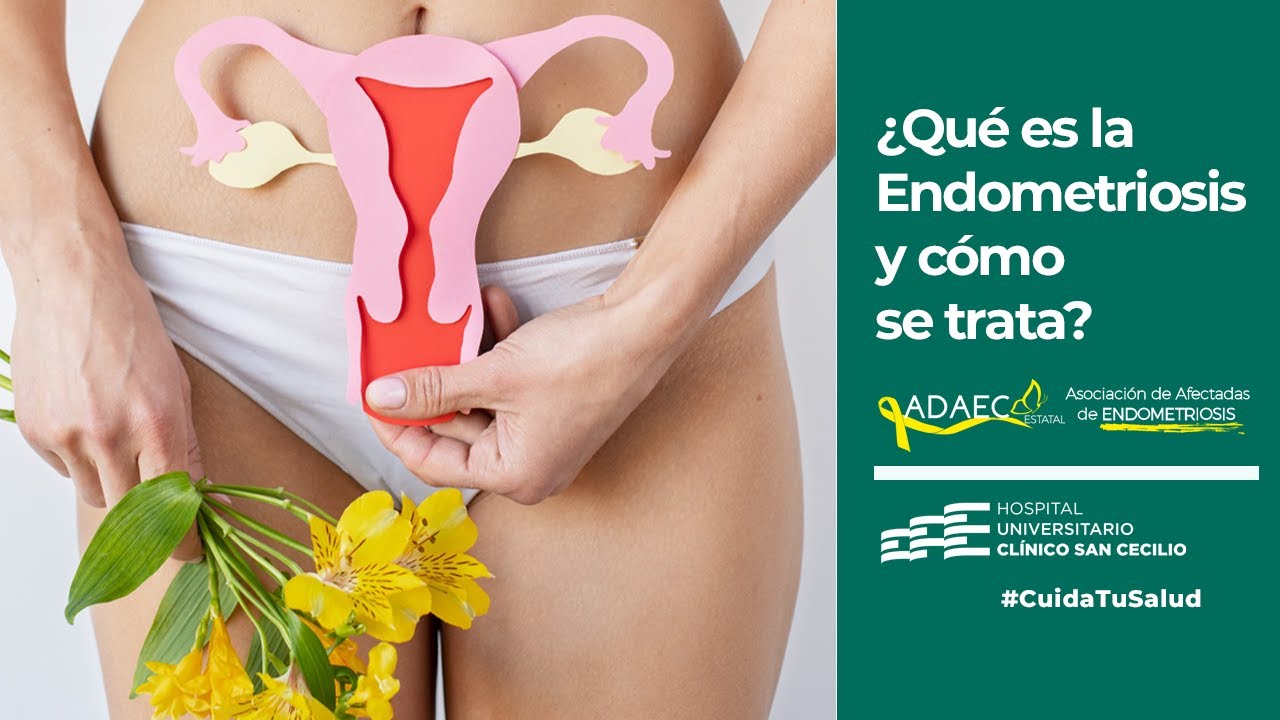 ¿Qué es la endometriosis? - Síntomas y tratamiento 