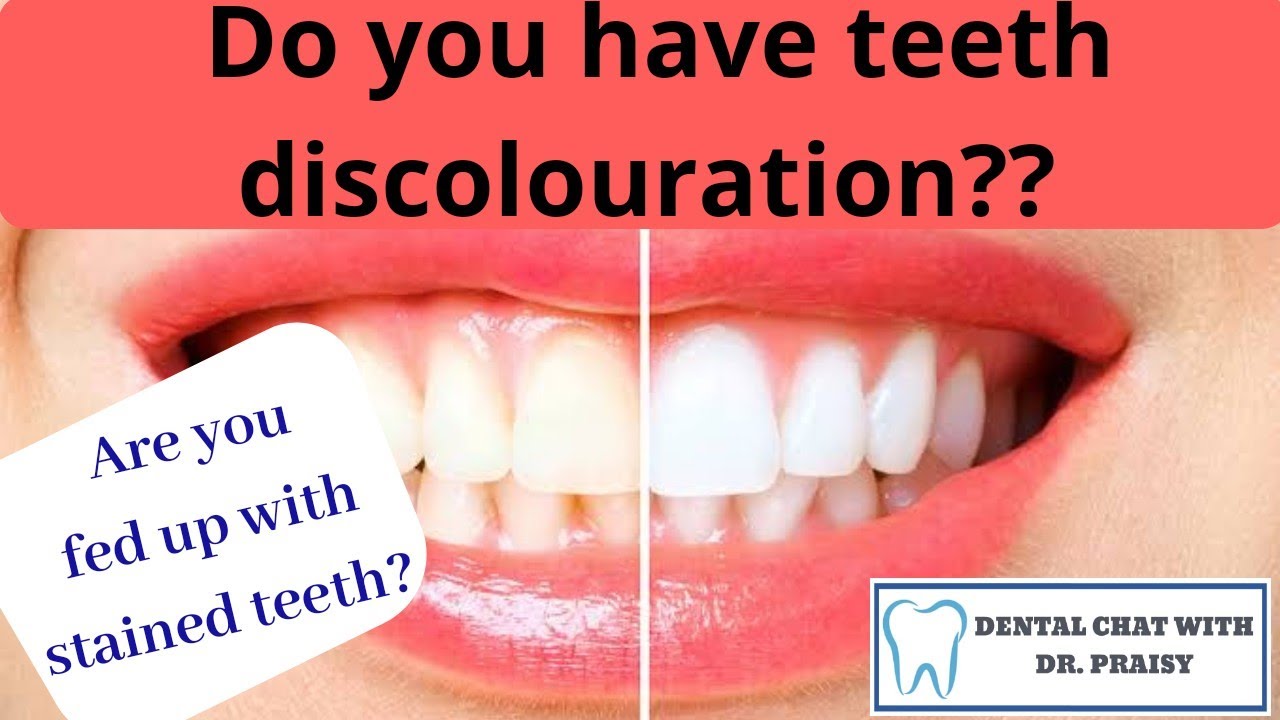 Do you have discoloured teeth?Do you know why it happens?How to manage it?Dental chat with Dr.Praisy