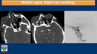 Middle aged. Right eye swelling.